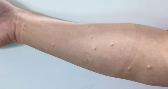 女子暴饮暴食皮肤出现大片黄疙瘩 医生:可能复发 需终身监测